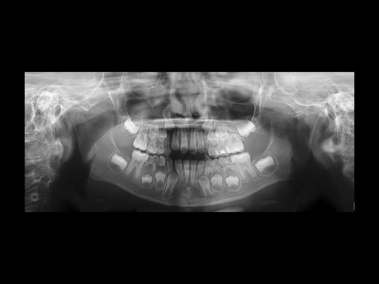 BK mostra radiografia de consumidores que deslocaram a mandíbula