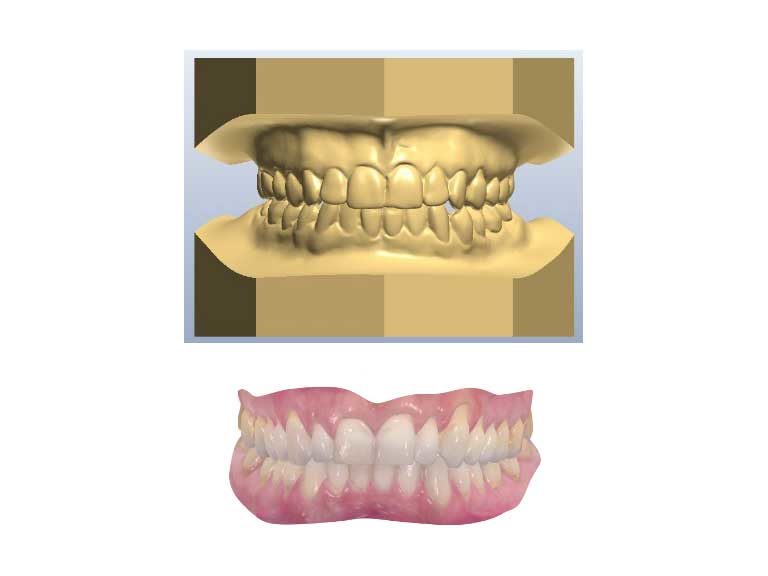 ibbro-modelo-arco-dentarios-01​