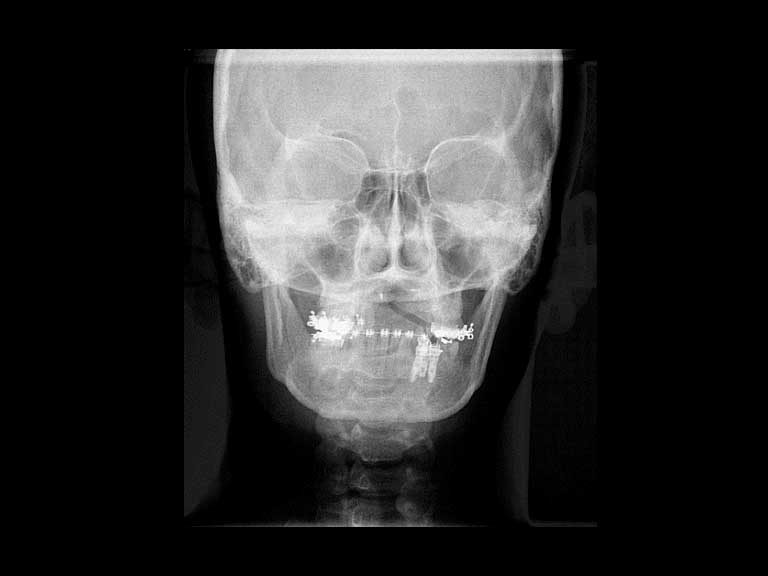 ibbro-telerradiografia-frontal