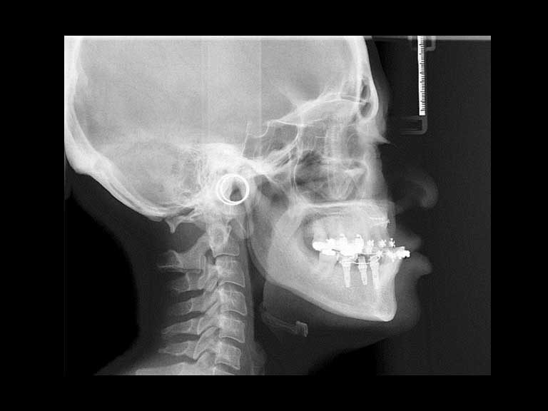 ibbro-telerradiografia-laterall