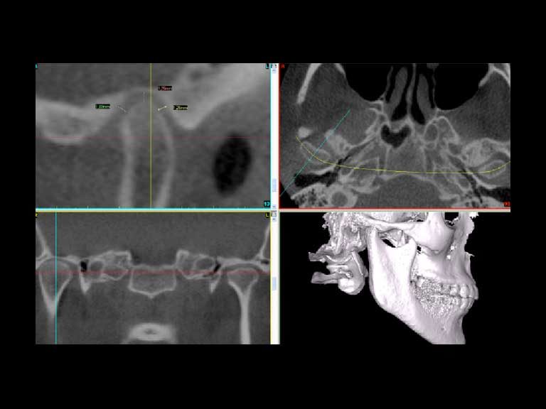 ibbro-tomografia-05