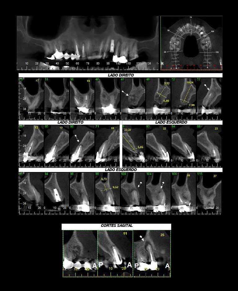 ibbro-tomografia-06