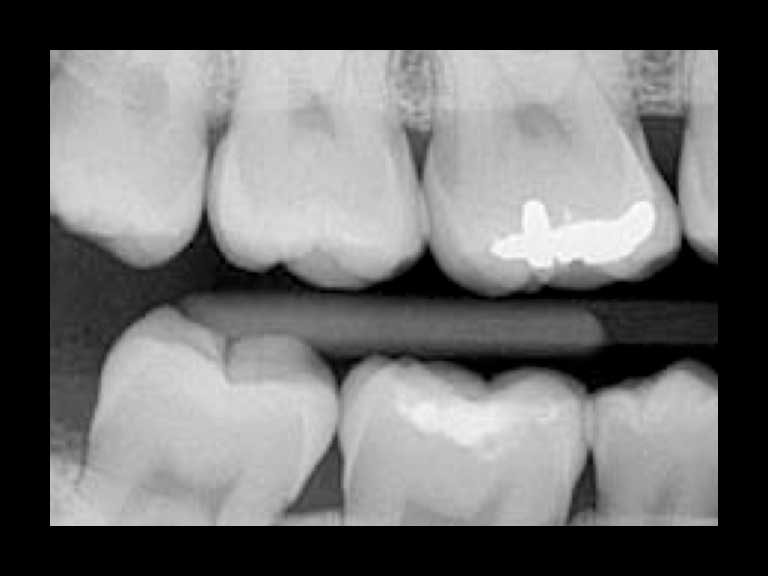 ibbro-interproximal