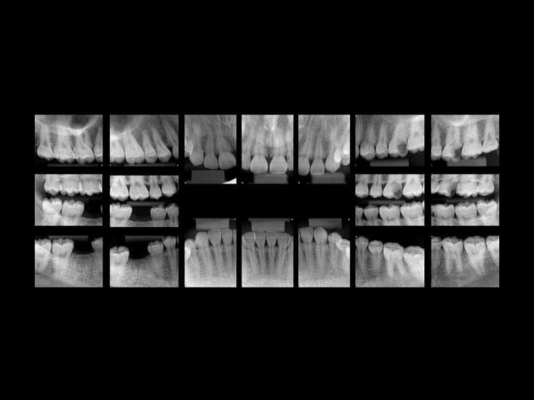 ibbro-interproximal02