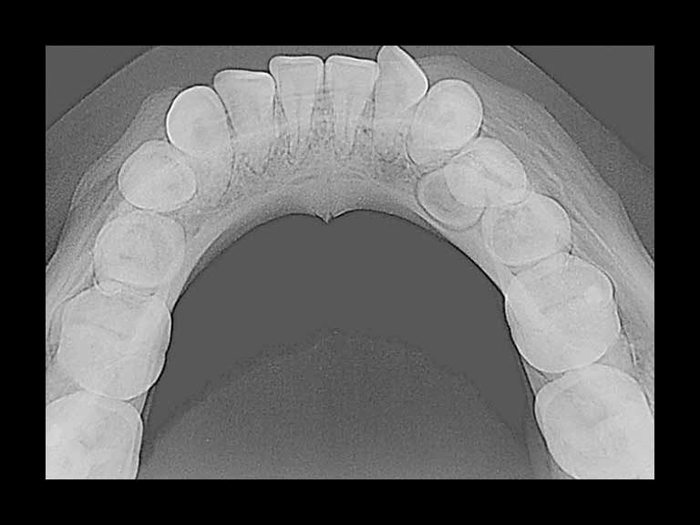 ibbro-oclusal-inferiror