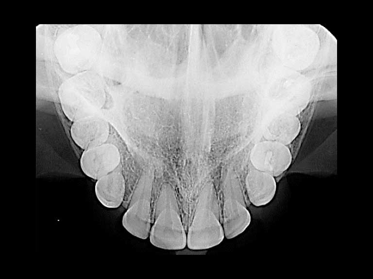 ibbro-oclusal-superior