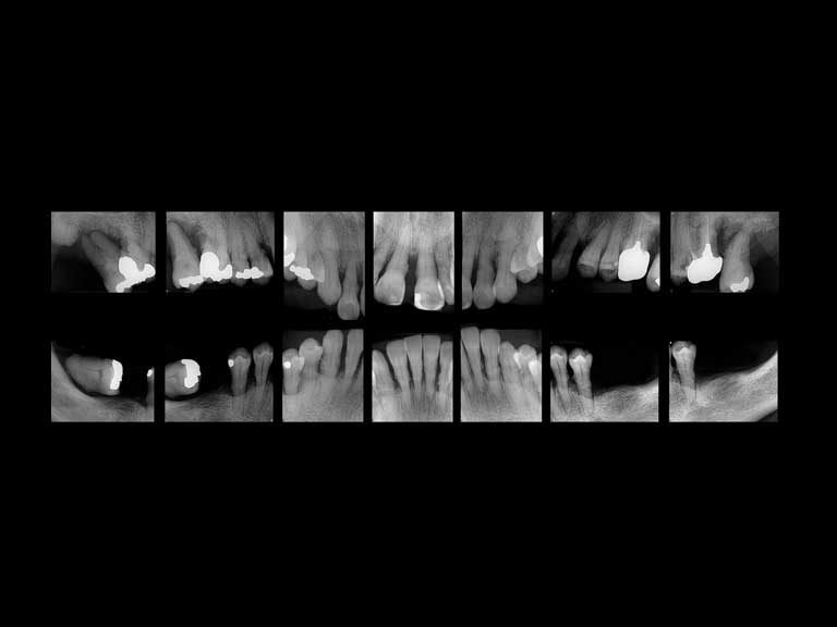 ibbro-periapical-01