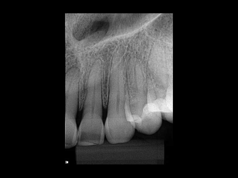 ibbro-periapical